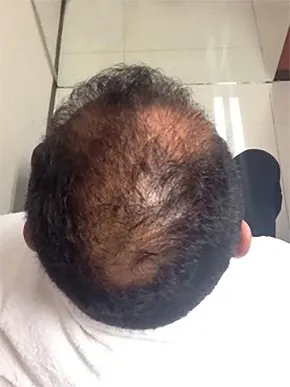 Caso 3: antes del tratamiento