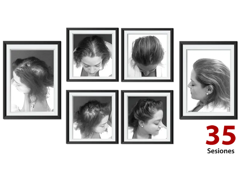 Detener caída cabello