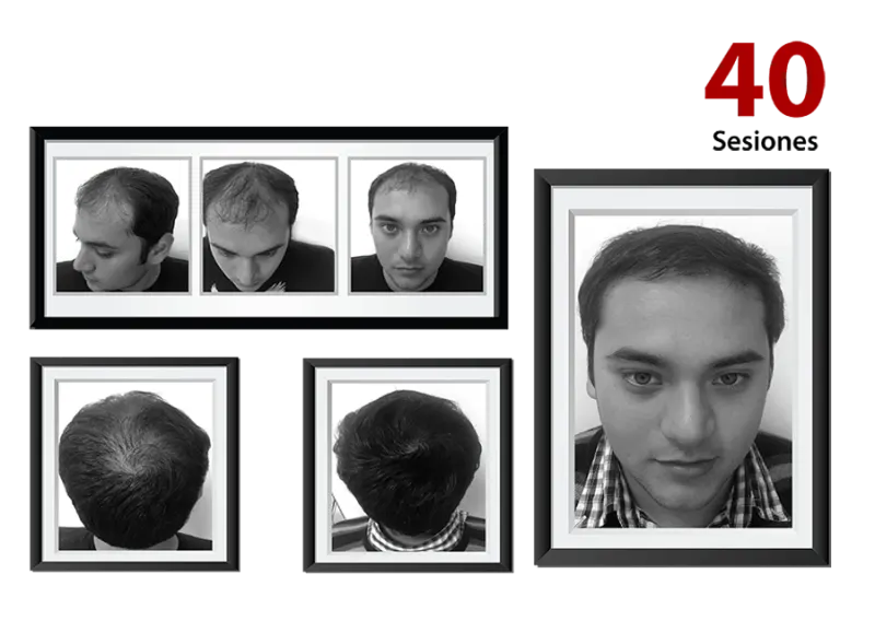 Detener caída cabello