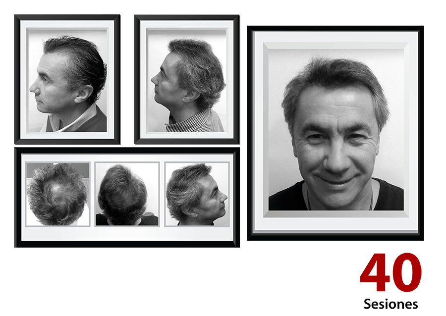 Detener caída cabello