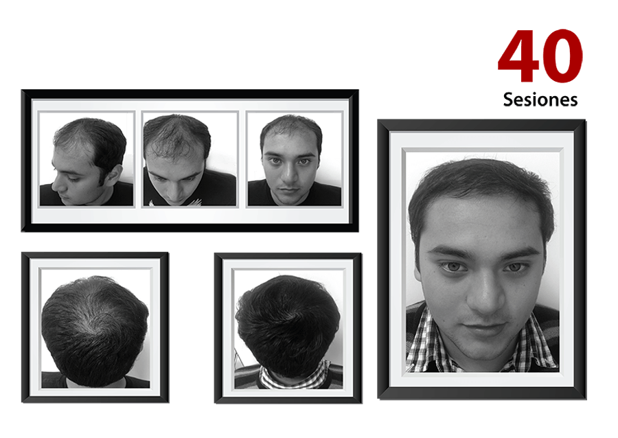 Detener caída cabello