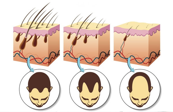 alopecia